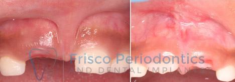 Before and After of a Frenectomy